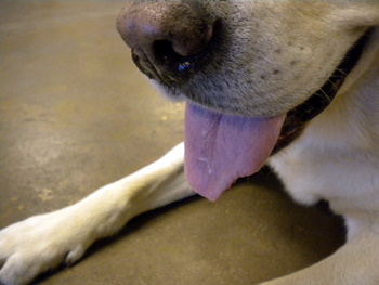 Brent's tongue four weeks after cancer surgery